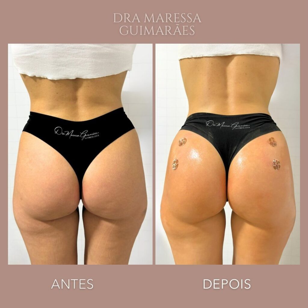 clinica-estetica-vila-maria-mahguimaraes-Bumbum-Tratamento-Corporal